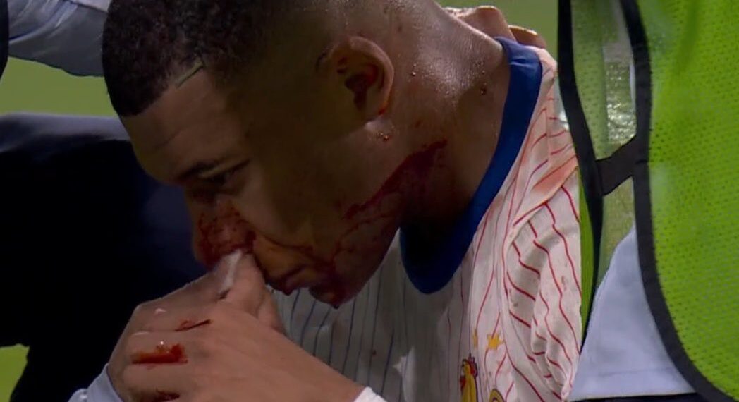 Alarmas en Francia y en Madrid, Mbappé se fracturó