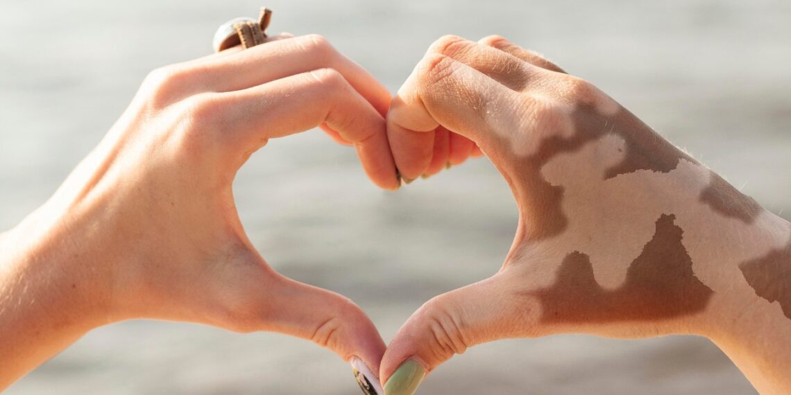 Piden normalizar el vitiligo para combatir la discriminación