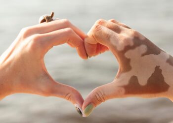 Piden normalizar el vitiligo para combatir la discriminación